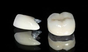 Tuổi thọ của răng sứ kim loại