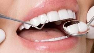 Cách chăm sóc để tăng tuổi thọ răng sứ