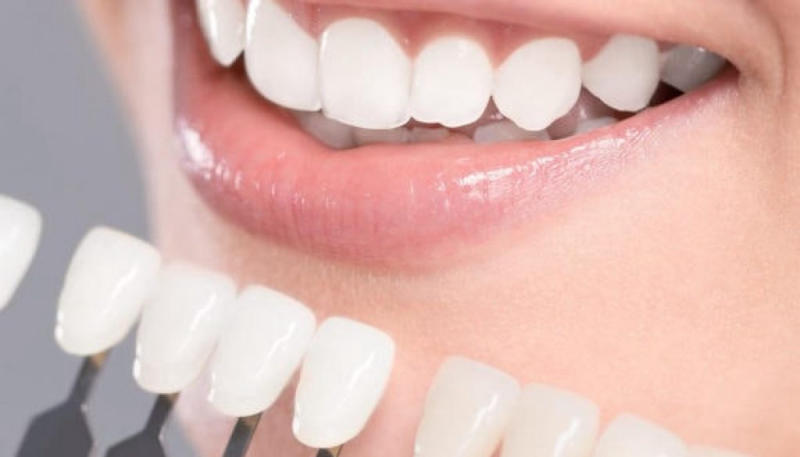 Tìm hiểu kỹ về phương pháp bọc răng sứ