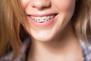 Niềng răng mắc cài kim loại bên ngoài