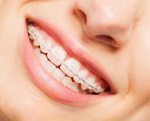 Niềng răng mắc cài sứ thẩm mỹ