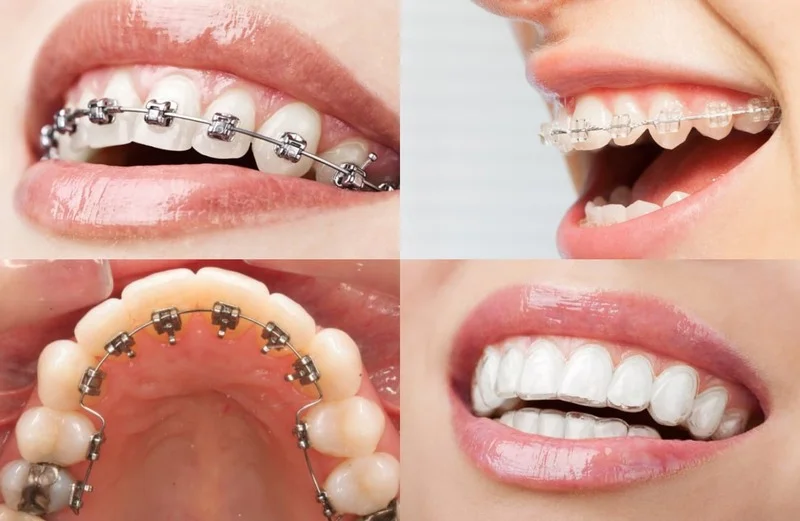 Các phương pháp niềng răng phổ biến
