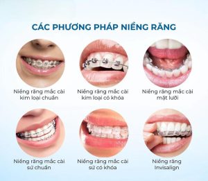 Các phương pháp niềng răng