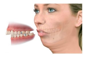 Răng hô làm giảm thẩm mỹ khuôn mặt