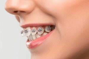 Niềng răng hô bằng phương pháp mắc cài
