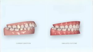 Kiểm soát mức độ dịch chuyển của răng hiệu quả
