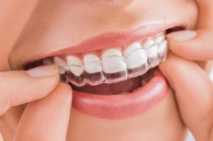 Kỹ thuật niềng răng invisalign