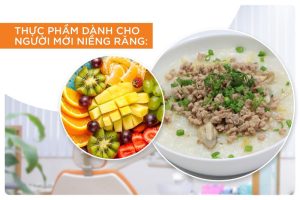 Chú ý về chế độ dinh dưỡng khi niềng
