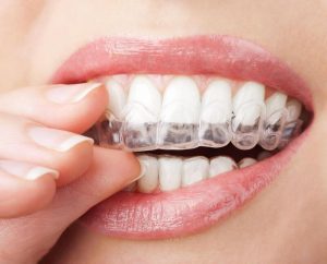 Niềng răng invisalign có tính thẩm mỹ cao