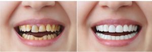 Trường hợp cần bọc răng sứ