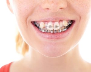 Một số trường hợp không cần phải cắm vít
