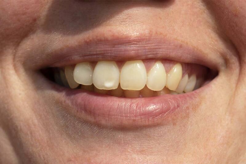 Răng có màu sắc không đẹp có thể dán sứ Veneer