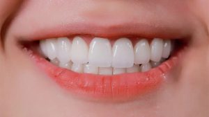Làm răng trắng, đẹp và tự tin hơn