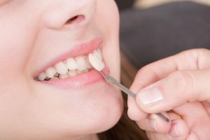 Tuổi thọ của mặt dán Veneer lên tới 8 năm