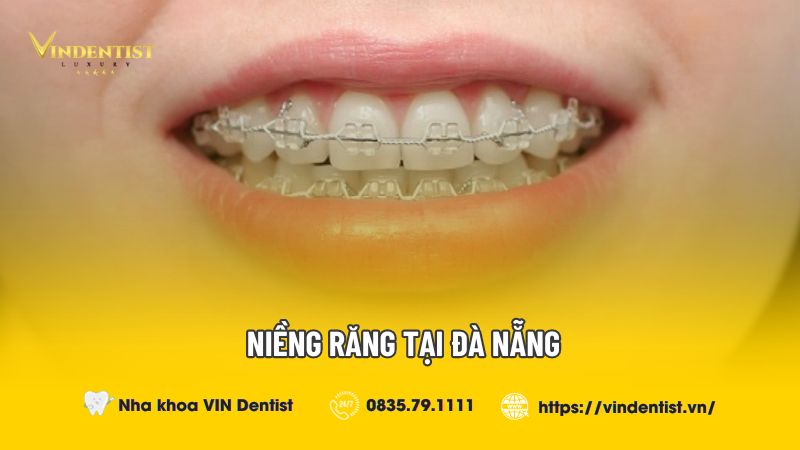 Dịch vụ niềng răng tại Đà Nẵng