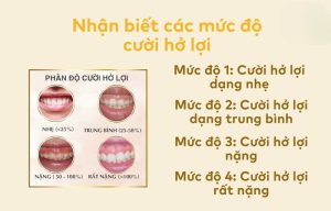 Các cấp độ cười hở lợi