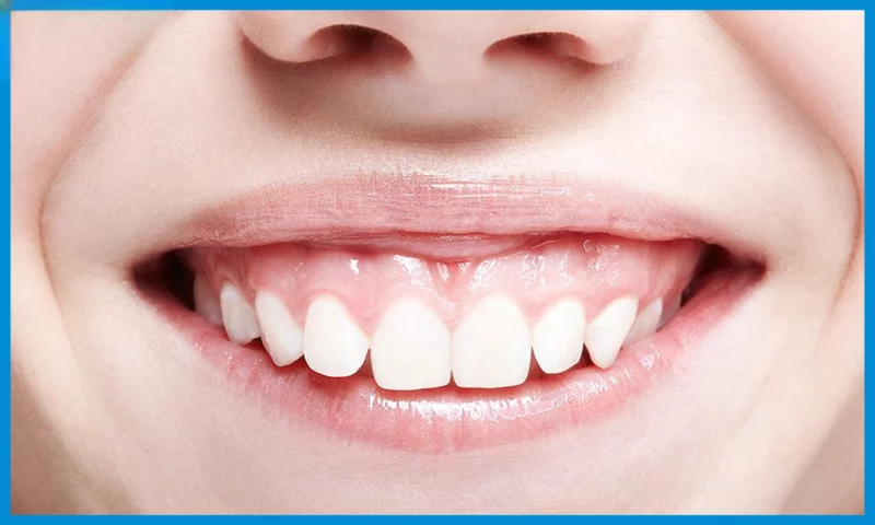 Dịch Vụ Điều Trị Cười Hở Lợi Đà Nẵng Uy Tín, Không Tái Phát 12 Cười hở lợi có thể do xương hàm