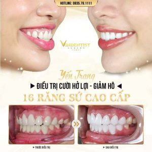 Hình ảnh khách hàng điều trị tại nha khoa