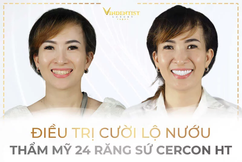 Dịch Vụ Điều Trị Cười Hở Lợi Đà Nẵng Uy Tín, Không Tái Phát 15 Kết quả điều trị cười hở lợi Đà Nẵng tại Nha khoa VIN Dentist