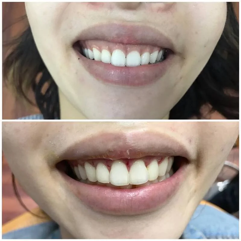 Dịch Vụ Điều Trị Cười Hở Lợi Đà Nẵng Uy Tín, Không Tái Phát 13 Phương pháp cắt lợi