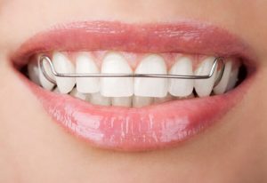 Giai đoạn đeo hàm duy trì