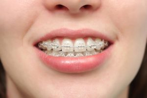 Niềng răng mắc cài sứ loại thường