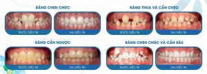 Các trường hợp thường gặp của răng