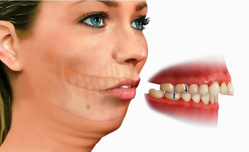 Niềng Răng Mất Bao Lâu Có Thể Tháo Được? 10 Niềng răng mất bao lâu?