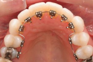 Niềng răng mặt trong hay còn gọi là niềng răng mặt lưỡi