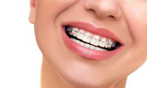 Niềng răng móm mắc cài sứ