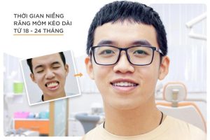Thời gian niềng răng móm kéo dài từ 18 - 24 tháng