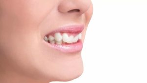 Răng dịch chuyển mạnh khó kiểm soát