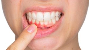 Có thể gây nhiễm trùng vùng nướu