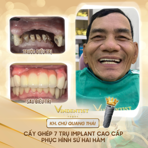 Ưu tiên chọn các địa chỉ nha khoa có ưu đãi