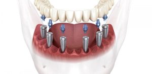 Phương pháp implant all on 6