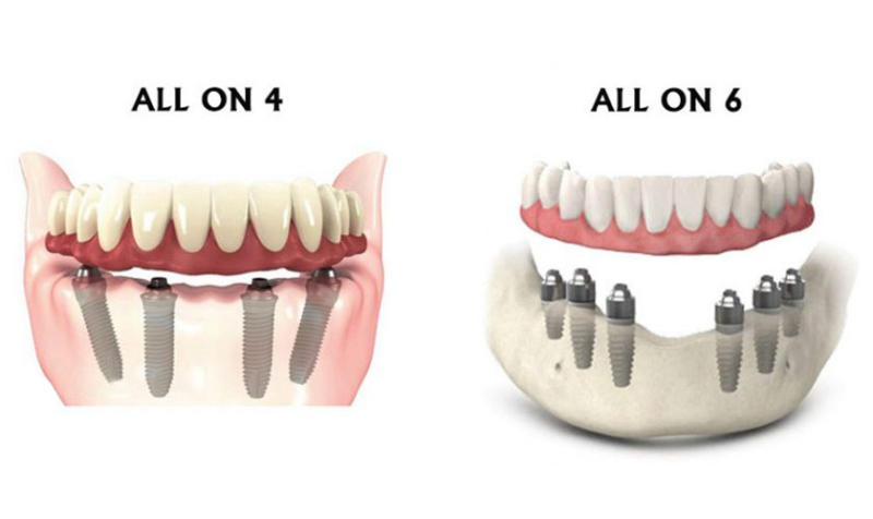 Lựa chọn phương pháp trồng răng implant hợp lý