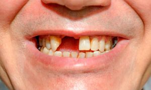 Người bị mất răng ở vị trí răng cửa