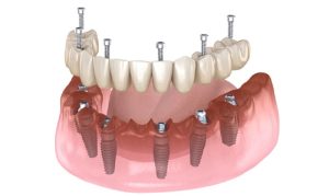 Trồng răng Implant all on 6