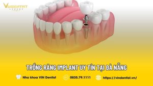Trồng răng Implant uy tín tại Đà Nẵng