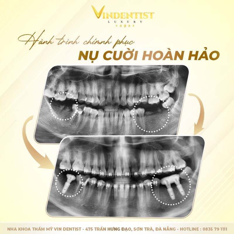 Dịch vụ Trồng Răng Implant Uy Tín Tại Đà Nẵng 29 Trồng răng Implant tại Nha khoa VIN Dentist