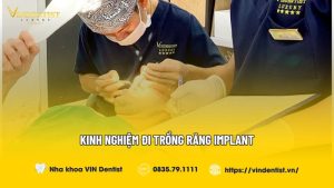 Kinh nghiệm đi trồng răng Implant
