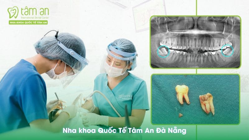 Khách hàng nhổ răng khôn tại Nha khoa Quốc tế Tâm An