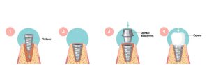 Quy trình trồng răng Implant 4S
