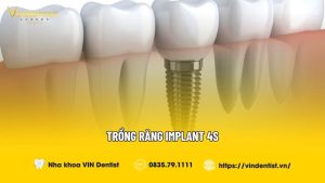 Trồng răng Implant 4S