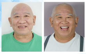 Điều chỉnh cấu trúc khuôn mặt