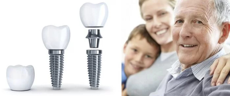 Các đối tượng phù hợp với phương pháp trồng răng Implant 4S