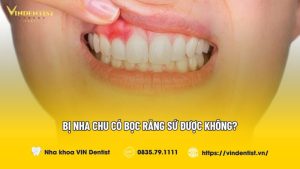 Bị nha chu có bọc răng sứ được không?