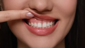 Răng khỏe mạnh bình thường mới có thể bọc răng sứ