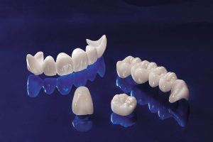 Ưu tiên bọc răng sứ chất lượng