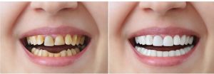 Tìm hiểu kỹ về phương pháp bọc răng sứ